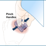 Revolutionizing Hemorrhage Control