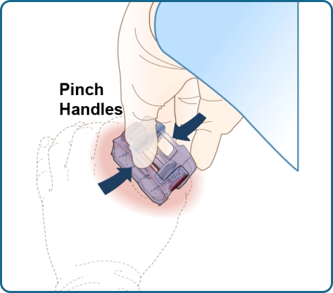 Revolutionizing Hemorrhage Control