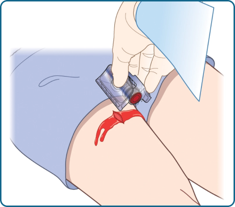 Revolutionizing Hemorrhage Control