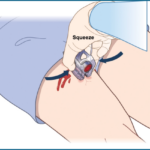 Revolutionizing Hemorrhage Control