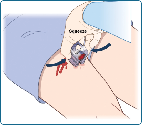 Revolutionizing Hemorrhage Control