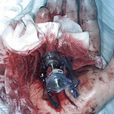 Falls and Accidental Wounds