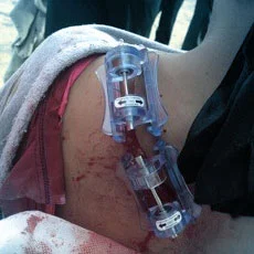 Penetrating Wounds